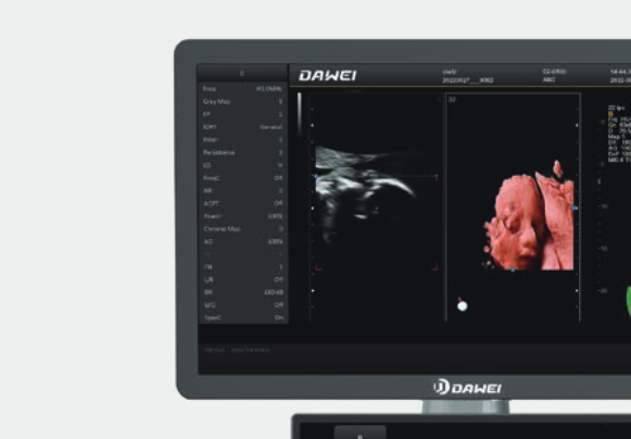 DW-T30 color ultrasound machine display