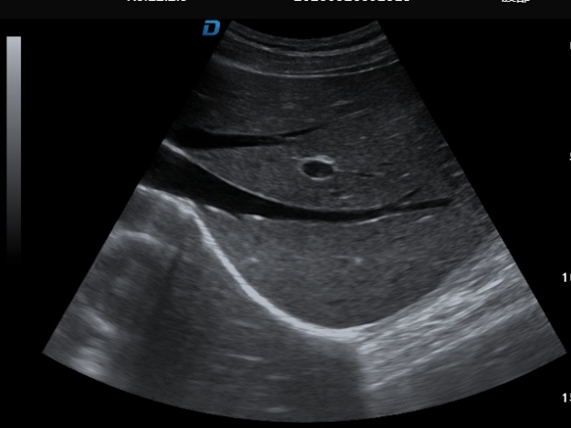 Liver imaging 