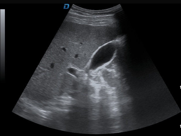 gallbladder imaging