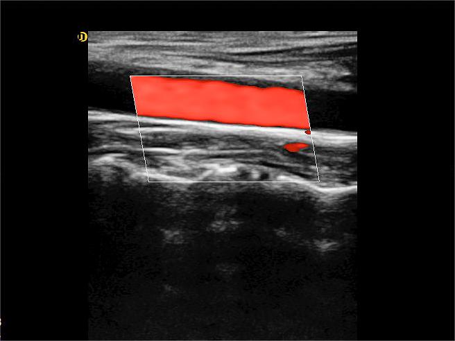 Tissue Harmonic Imaging (THI)