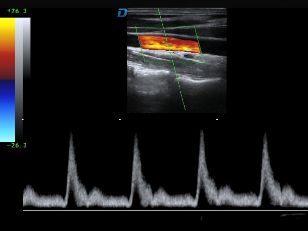 carotid imaging