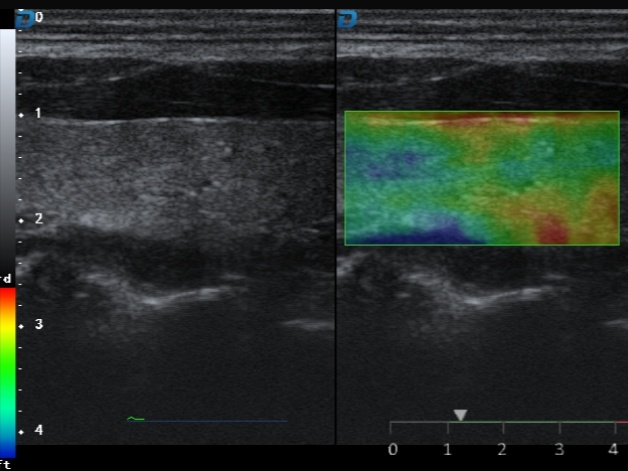 Elastography